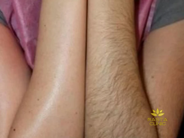 عوامل موثر در رشد موهای زائد
