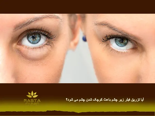عکس قبل و بعد از تزریق ژل زیر چشم