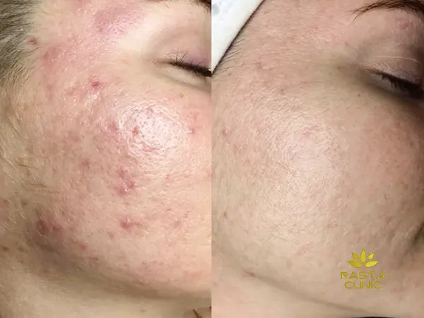 هزینه لیزر co2 برای جای جوش