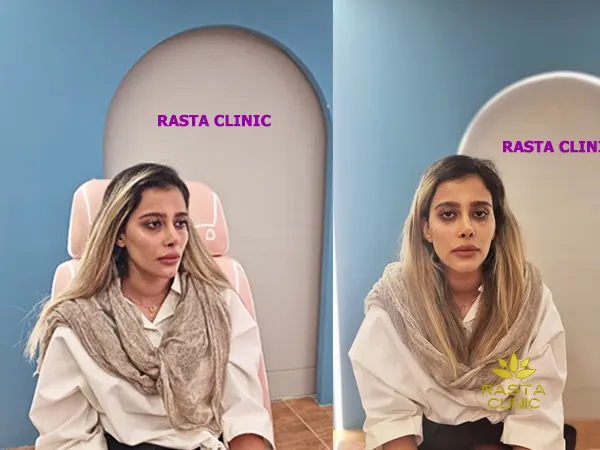 عکس قبل و بعد تزریق فیلر گونه برای اصلاح تناسب صورت