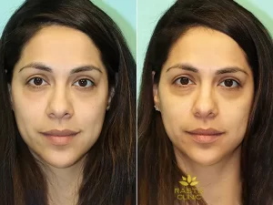 آیا تزریق فیلر زیر چشم باعث کوچک شدن چشم می شود؟