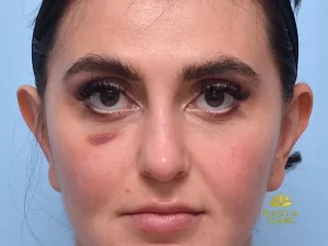 عوارض فیلر زیر چشم در طولانی مدت