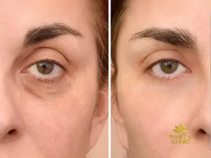 فیلر زیر چشم بهتر است یا مزوتراپی