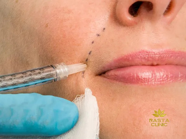 بهترین ذکتر تزریق ژل خط خنده در اصفهان