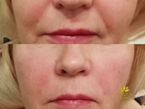 عکس قبل و بعد تزریق ژل خط خنده در اصفهان