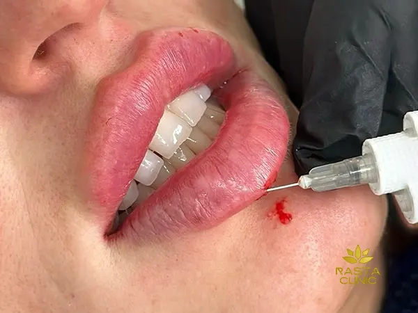 تزریق فیلر لب طبیعی در اصفهان