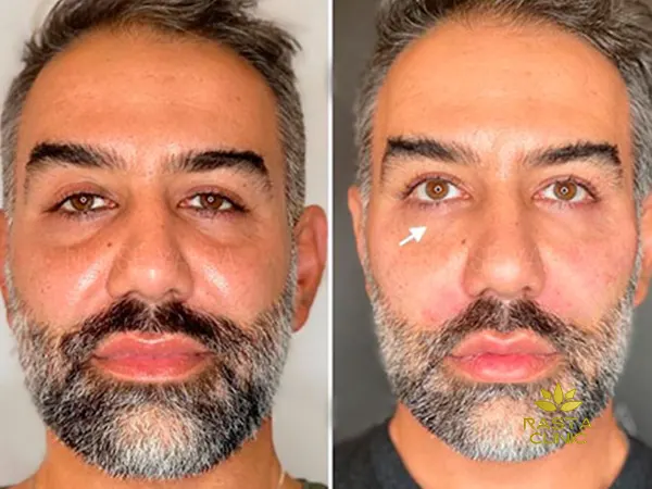 عکس های قبل و بعد فیلر زیر چشم