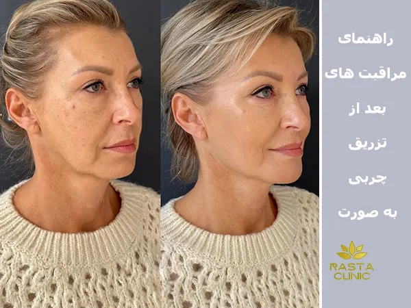 مراقبت های بعد از تزریق چربی به صورت
