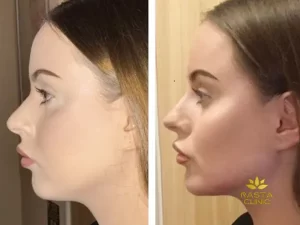 عکس فیلر گونه قبل و بعد از تزریق