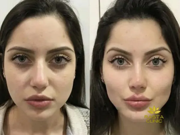 انواع لیفت چشم