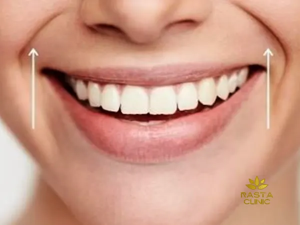 تزریق فیلرخط خنده