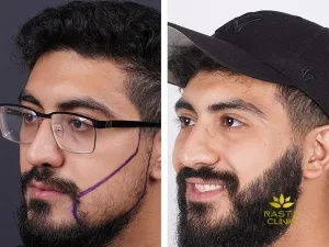هزینه کاشت ریش و سبیل در اصفهان