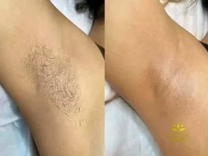 عکس قبل و بعد لیزر زیر بغل
