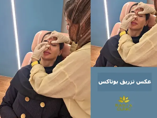 عکس تزریق بوتاکس قبل و بعد واقعی