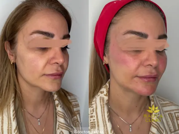 تزریق فیلر گونه در اصفهان