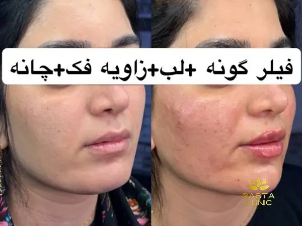 تزریق فیلر برای صورت لاغر و کشیده