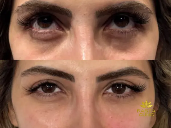 عکس فیلر زیر چشم در اصفهان