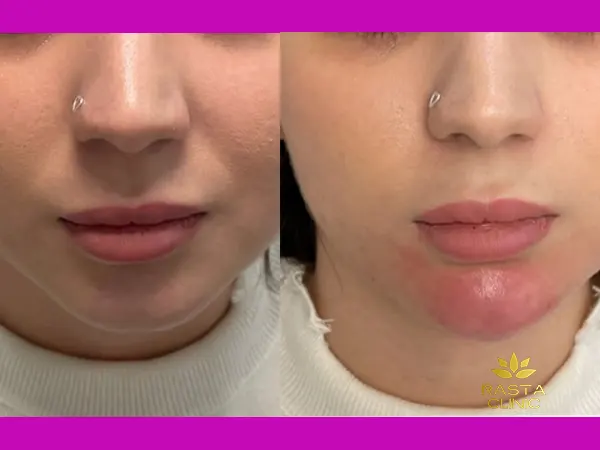 عکس فیلر چانه در اصفهان