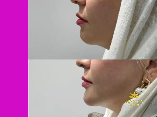 فیلر چانه اصفهان